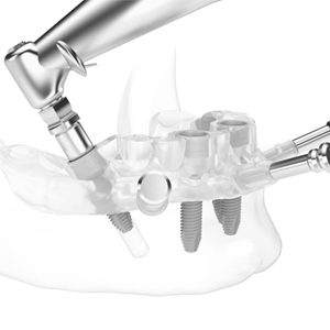 Sistemas CAD CAM para odontología en Córdoba